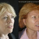 52 Year Old Lady The Day After Quicklift Under Local Anaesthesia Alone