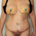 6 days post op .First time I say my naked body on the mirror after operation