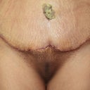 6 days post op  Belly still cover, hope to see it next week