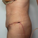 6 days post op