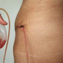6 days post op. I wanted to show a closer look of the drain hole, Nasty!!