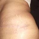 Left scar 14 weeks