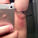 2nd Treatment - Day 1