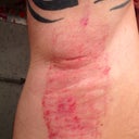 2nd Treatment - Day 1