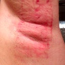 2nd Treatment - Day 1
