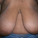 4 days before surgery... I decided to take the plunge. Hopefully I will never have to see such them looking like this ever again.