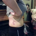 6 days post op, side view!