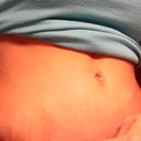 AFTER: (4 weeks post op) Look at where that mole is!