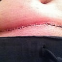 1 wk PO, close-up -staples