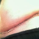 1 wk PO close-up, other side. No drain. I had 1 only.