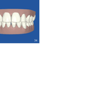ClinCheck: Final tray