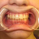 Front view of my "pre" teeth