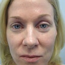 Before - taken day of procedure at Drs office