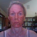 A few hours after the procedure-red and crusty