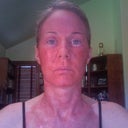 Three days after procedure-pronounced redness on neck and chest