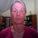 Five days after procedure-still quite red, some peeling