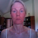 Six days after procedure-still red