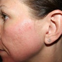 Day #4 left - pretty much all the skin has sloughed off, but you can see the roadrash areas on my chin and pinpoint bleeding areas. You can see that the age spot on the left has come off.