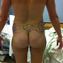PS markings just prior to surgery. Here you can see all the hash markings he made indicating where lipo will be performed.