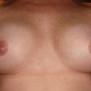 6 weeks post op.