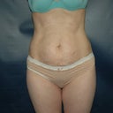 Pre-op