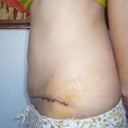 Day 5 post-op side view