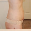 3 weeks post-op (swelling!)