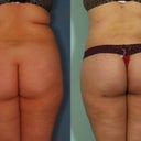 Buttock Lift