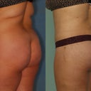 Buttock Lift