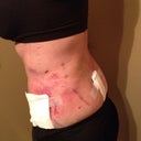 post op 1 DAY