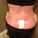 post op 1 DAY