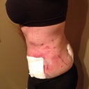 post op 1 DAY