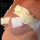 before Dr.Turkeltaub did his surgery on me this was from another doctor