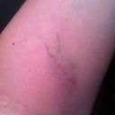 See?  The arm bruise IS worse.  I told the anesthesiologist to use the other arm!