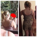 This is the back fat I was disappointed with. Obviously a skin tight faja is going to squeeze the fat and make it look worse than it really is. But I was thinking if I was going to lipo it why not put it in the booty!! Lol