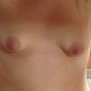 Uneven tuberous breast deformity.