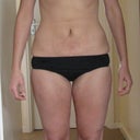 4 1/2 months post Vaser to abs, flanks and saddlebags