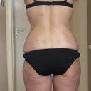 4 1/2 months post Vaser to abs flanks and saddlebags