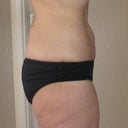 4 1/2 months post Vaser to abs, flanks and saddlebags