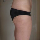 Side Before Vaser