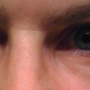 12/29/2012  14 months after first Restylane injection.