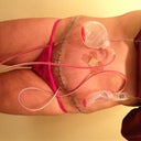 Taken yesterday, 5 days post op
