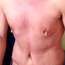 1 day post op