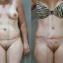 Before and After