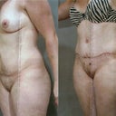 Before and After