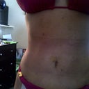 Front view flat tummy 10 days post op still swollen.