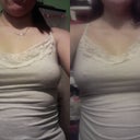 cami no bra Before and 8 days post op