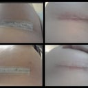 Incision Day 6, 14 Post op left and right