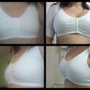 6 Days Post op and obviously the before shots, Today was the day i felt the greatest physically and then every day after has been better.