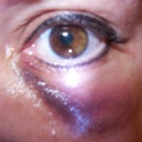 The day of injection with Artefill upto 24 hours later.  They hit a blood vessel on one eye.  Greatly swollen. I iced it, then switched to warm compresses and massage.